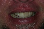 All Porcelain Crown A Porcelain Fused to metal crown with an exposed metal margin was replaced with an all por