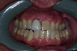 All Porcelain Crown A Porcelain Fused to metal crown with an exposed metal margin was replaced with an all por