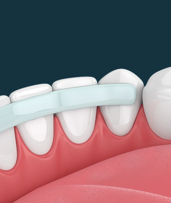 Dental bonding restoring the shape of front teeth