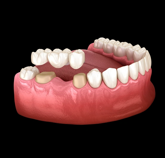 Dental bridge restoring several missing teeth