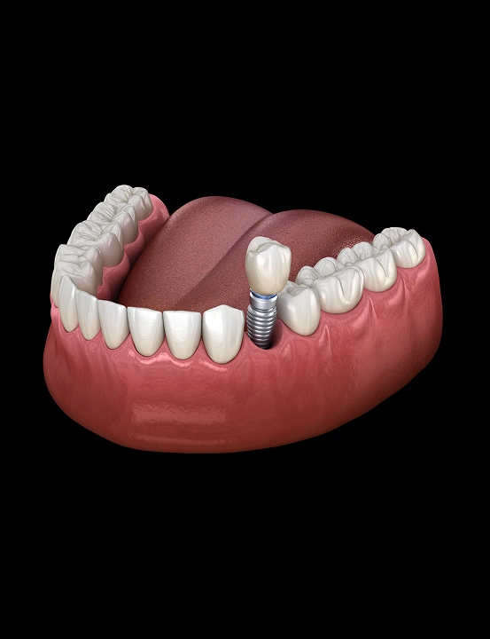 Dental implant supporting a replacement tooth