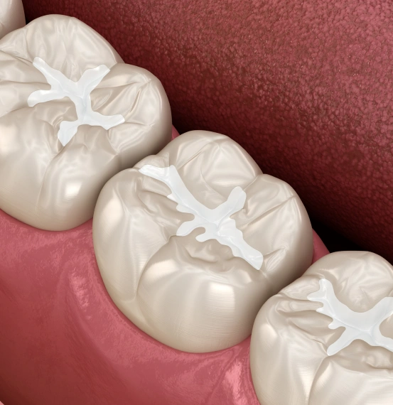 Dental sealants protecting the chewing surfaces of molars