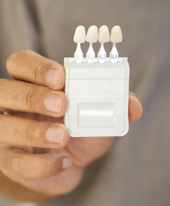 Porcelain veneer shade guide held for cosmetic treatment planning