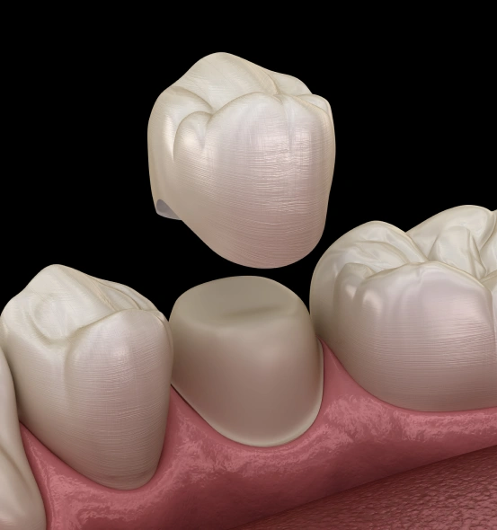 Ceramic dental crowns placed on prepared teeth