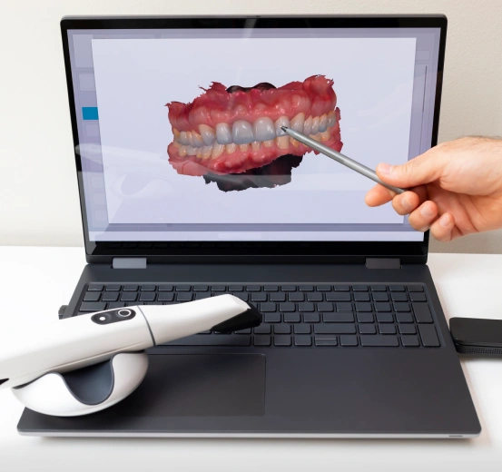 Digital intraoral scanner creating a three dimensional dental model